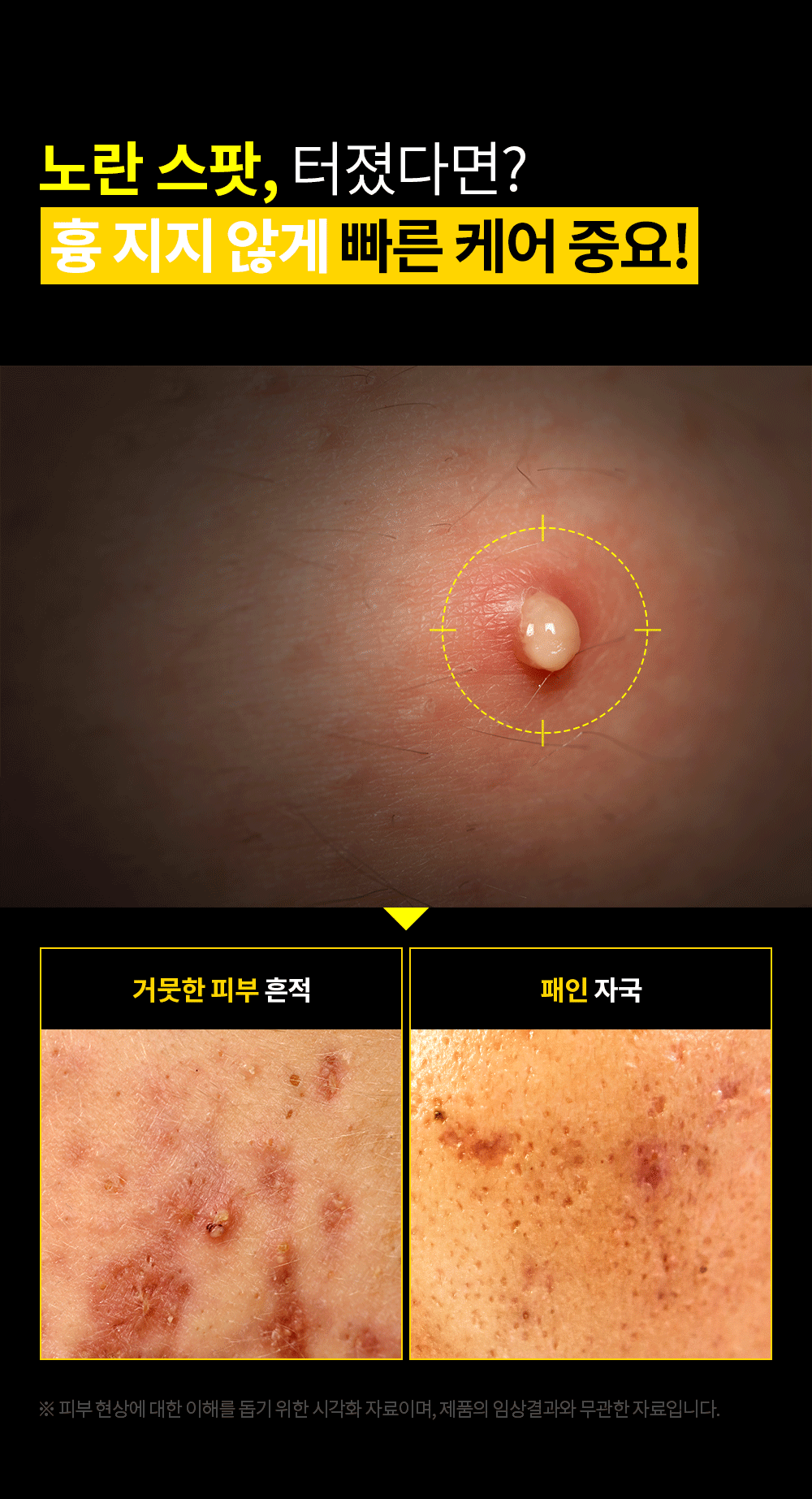 韓國 Troubless Invisible Spot Patch #Classic 極透薄隱形痘痘貼 - 96片裝