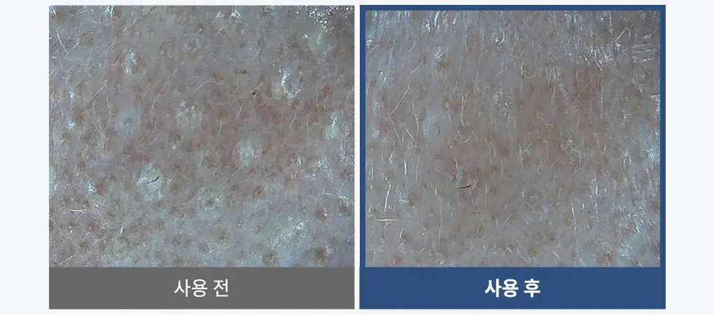 韓國 B Project Bye Blackhead Melting Remover 告別黑頭溶解清毛孔黑頭白頭導出酵素精華連清潔刷頭