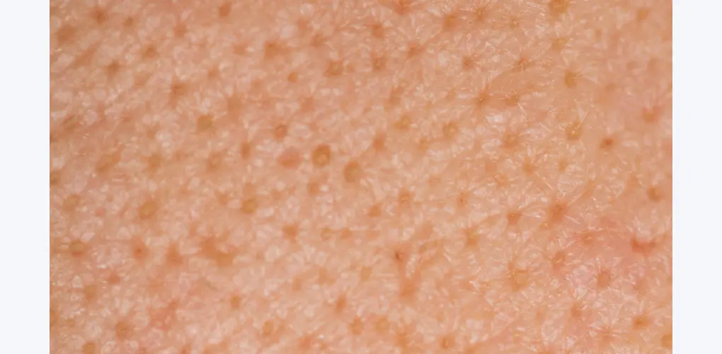 韓國 B Project Bye Blackhead Melting Remover 告別黑頭溶解清毛孔黑頭白頭導出酵素精華連清潔刷頭