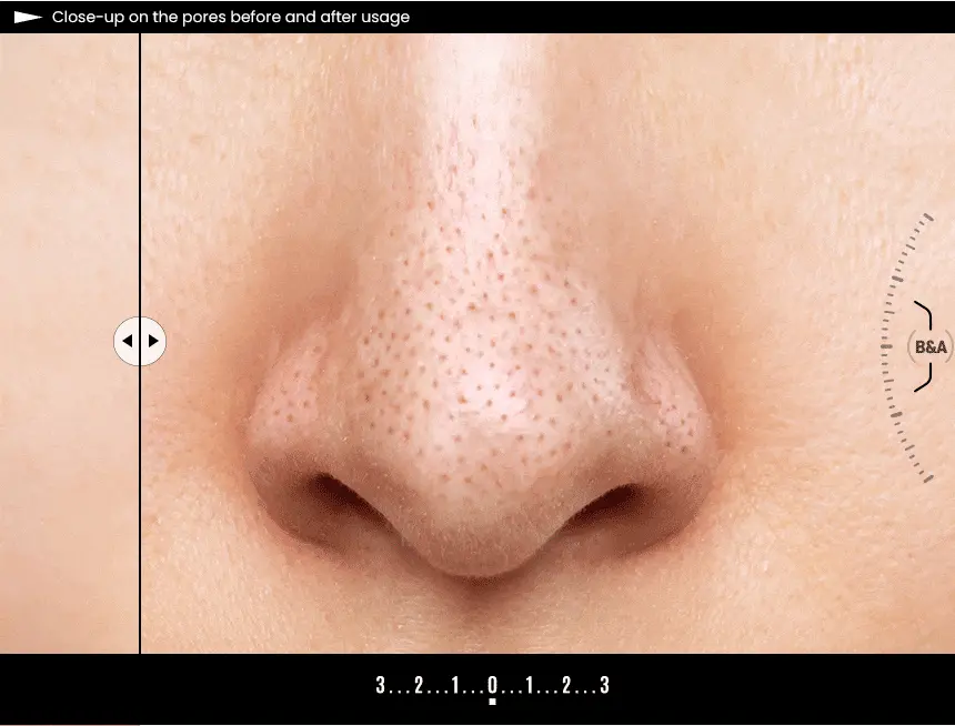 韓國 ilso Super Melting Sebum Softener 黑頭粉刺導出液