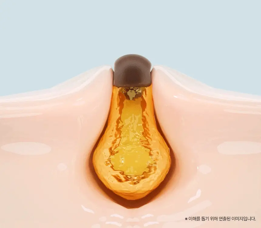 韓國 ilso Super Melting Sebum Softener 黑頭粉刺導出液