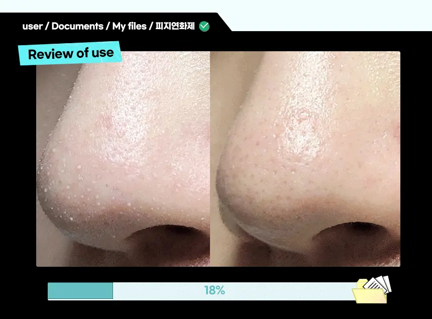 韓國 ilso Super Melting Sebum Softener 黑頭粉刺導出液