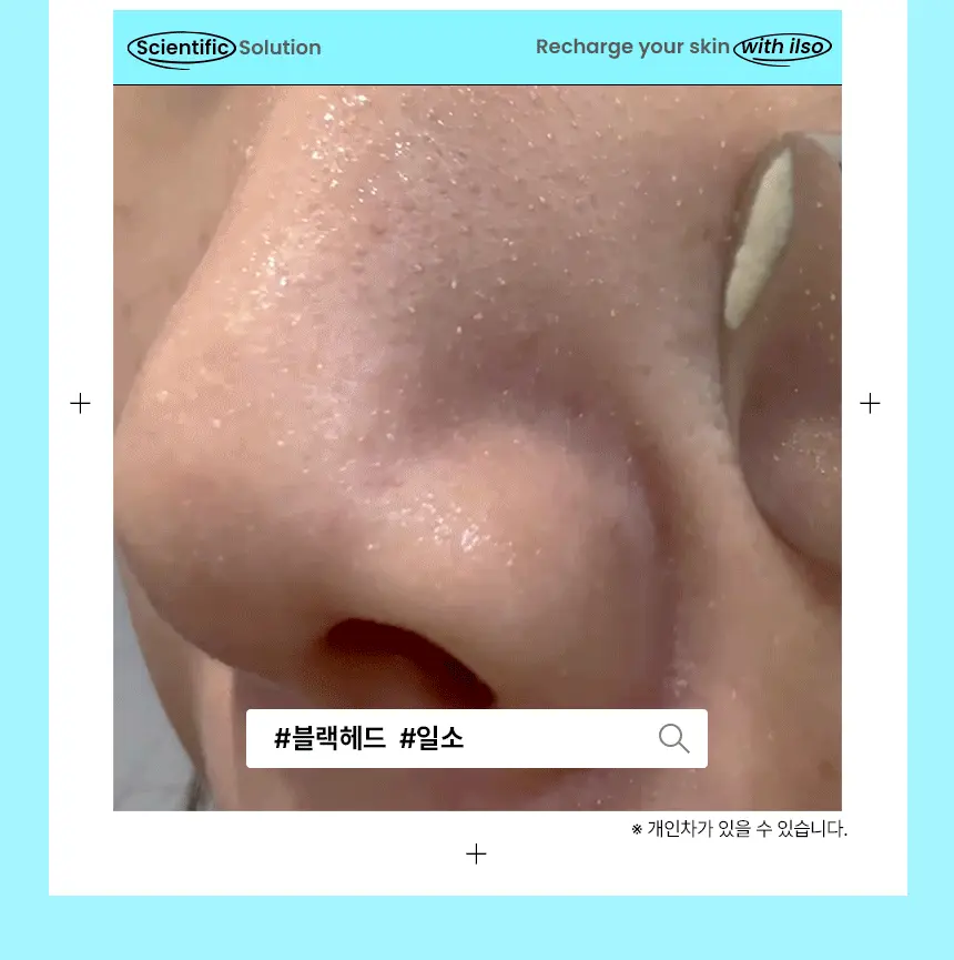 韓國 ilso Super Melting Sebum Softener 黑頭粉刺導出液
