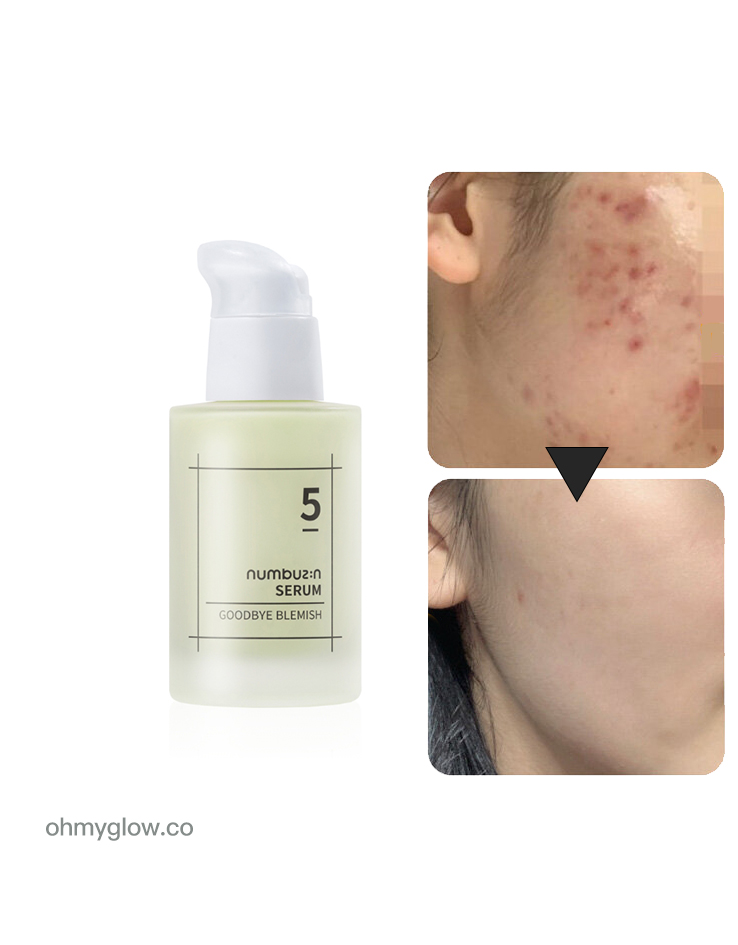 去紅淡斑去痘印！韓國 numbuzin No.5 Goodbye Blemish Serum 5號告別瑕疵精華 - 50ml