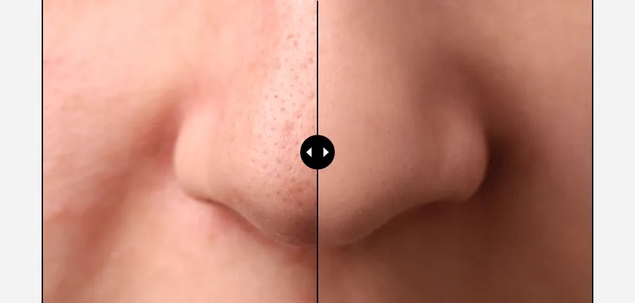 新升級2.0!韓國 Medi Peel Extra Super 9+ Blackhead Care Solution 2.0 黑頭清道夫淨鼻清潔液 - 250ml