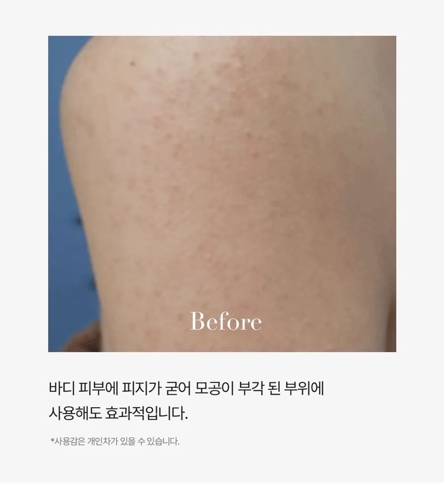 新升級2.0!韓國 Medi Peel Extra Super 9+ Blackhead Care Solution 2.0 黑頭清道夫淨鼻清潔液 - 250ml