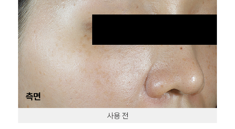 韓國黑科技 醫美級無痛緊緻提拉!BioHeal BOH x Oligio Probioderm 3D Lifting Voluming Patch 益生菌3D提拉抗老高彈性凝膠面頰面膜 4+1P - 5片裝