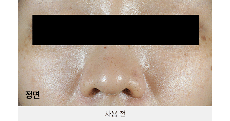 韓國黑科技 醫美級無痛緊緻提拉!BioHeal BOH x Oligio Probioderm 3D Lifting Voluming Patch 益生菌3D提拉抗老高彈性凝膠面頰面膜 4+1P - 5片裝