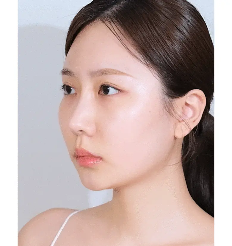 韓國黑科技 醫美級無痛緊緻提拉!BioHeal BOH x Oligio Probioderm 3D Lifting Voluming Patch 益生菌3D提拉抗老高彈性凝膠面頰面膜 4+1P - 5片裝