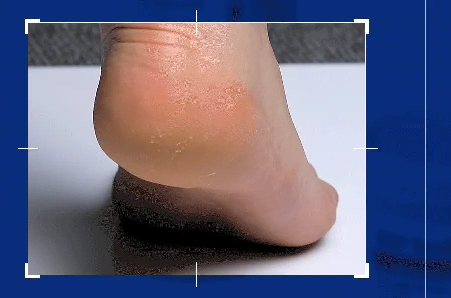 韓國 Medi Peel EGF Scaling Moisture Foot Cream 腳踭足部去角質龜裂保濕霜 130g