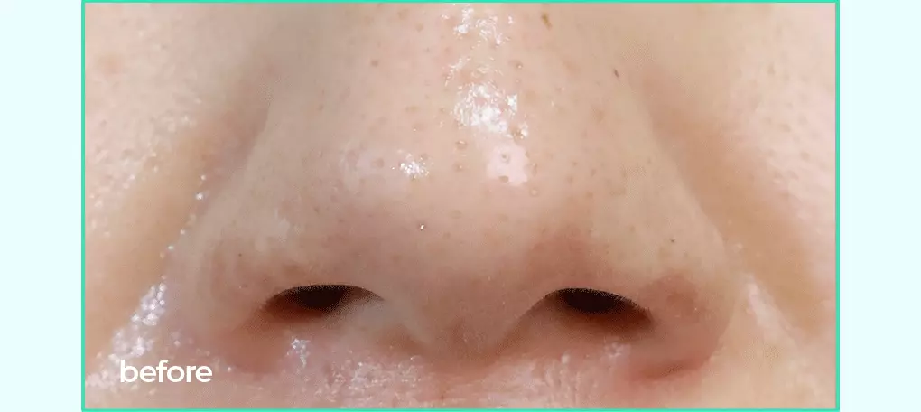 【送清黑頭皮脂棒】GlowPick🏆 韓國 Bring Green Tea Tree CICA Sebum Cleansing Gel (+Sebum Cleaner Set) 樹茶積雪草潔面皮脂軟化深清毛孔黑頭凝膠凝膠 - 50ml
