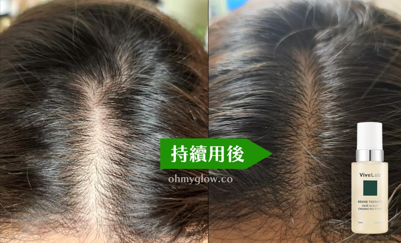4週脫髮減少58.8%～韓國防脫生髮頭皮專家 ViveLab Revive Therapy Hair Scalp Enhancing Foam 煥活頭皮修復高濃縮泡泡營養液 (100ml/33ml) - 2種選擇