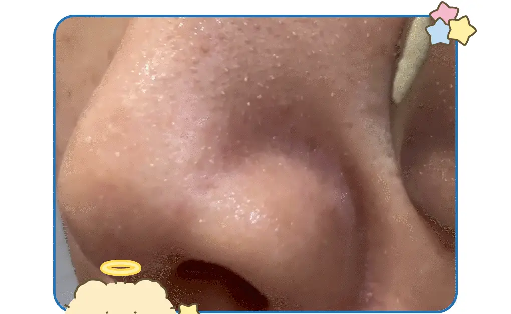 【限量聯名SET 送棉片+黑頭刮刮棒】韓國 ilso x 망그러진곰 Softener Gift Set 黑頭粉刺導出液優惠SET 連深清刮刮棒+棉片