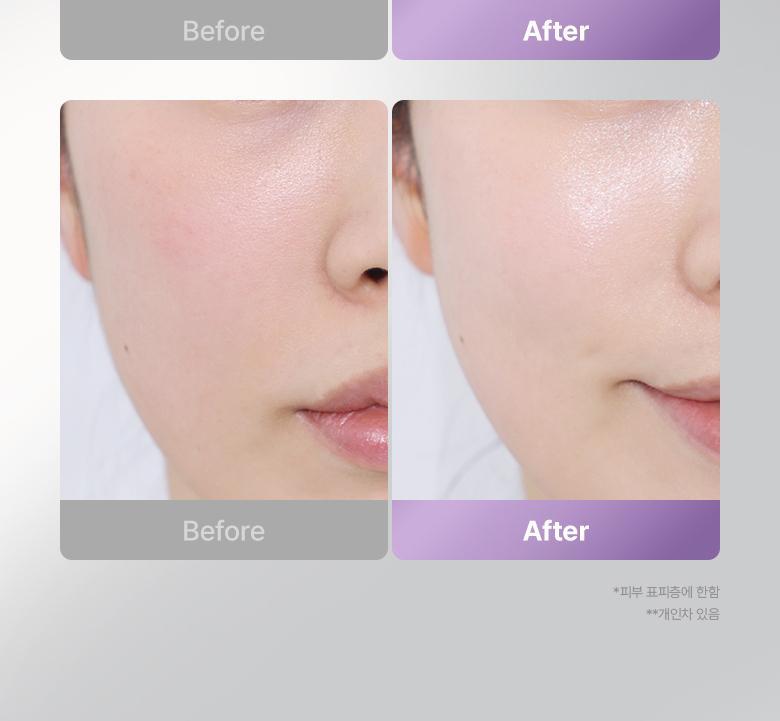 \最新升級2.0 3合1美容儀/ 限量SET送面膜～家用醫美級美容 韓國 Bioheal BOH X SHURINK Collagen Serum Set 重塑膠原彈力光澤雙效美容儀＋精華護理套裝送面膜