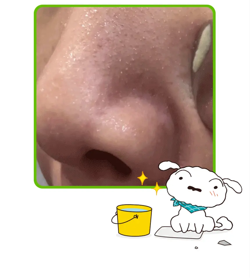 【限量SET 送棉片+黑頭刮刮棒+貼紙】韓國 ILSO X 蠟筆小新 Super Melting Sebum Softener 黑頭粉刺導出液優惠SET 連深清刮刮棒+棉片+貼紙