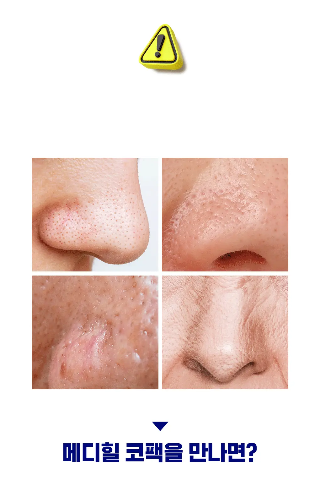 化解🏆 韓國Mediheal Blackhead Melting Clear Nose Patch 鼻頭清黑頭角質溶解清潔貼附刮刮棒 - 4片裝
